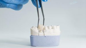 czy korony na cyrkonie moga stac sie bezkompromisowa alternatywa dla porcelany.jpg